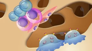 Pathogenesis and Treatment of Myeloma Bone Disease