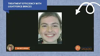 Treatment Efficiency with Lightforce Braces! | Joosse Family Orthodontics | Williamsburg, VA