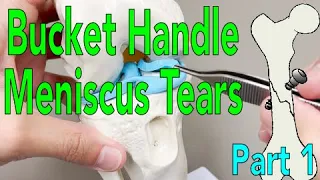 Bucket Handle Meniscus Tears   - Part 1