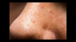 How to Remove Blackheads Permanently