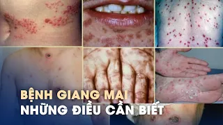 Đừng chủ quan với các dấu hiệu cảnh báo bệnh giang mai