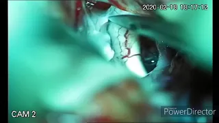 Anterior Communicating Artery Aneurysm Clipping