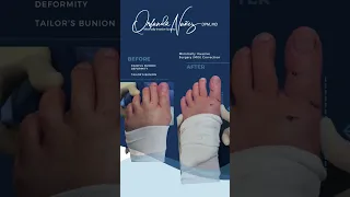 Painful Bunion Deformity - Tailor's Bunion