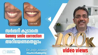 Gummy Smile Treatment without Surgery Dr.Jojo Joseph, Orthodontist, Vallamattam Advanced Orthodontic