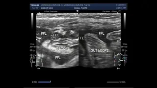 Ultrasound Video showing Intestinal obstruction with perforation.