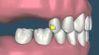 Perda dental e suas consequências - vídeo 2