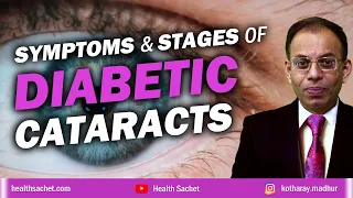 Signs, symptoms and stages of cataracts in diabetes