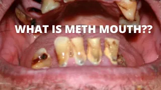 What is Meth Mouth? The results of methamphetamine abuse.