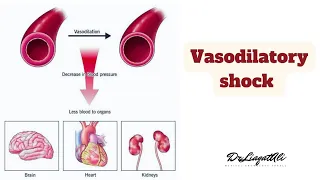 VASODILATORY SHOCK |DRLIAQATALI|#shorts