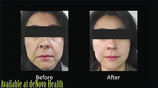 FOTONA 4D   Laser Skin Tightening