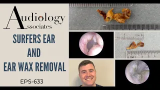 SURFERS EAR & EAR WAX REMOVAL - EP633