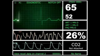 Hospital Monitor with FlatLine (M) (HD)