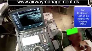 Locating and marking the cricothyroid membrane with ultrasonography airwaymanagement