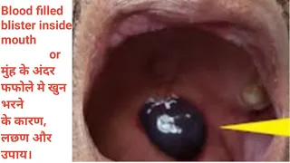 Blood filled blister inside mouth & it's sign. मुंह के अंदर खुन भरे फफोले बनने के कारण , लछण और उपाय