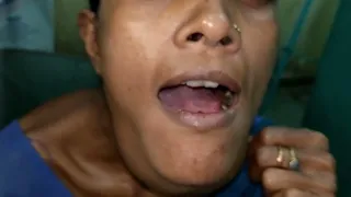 Huge Sublingual Dermoid Cyst Excision through neck