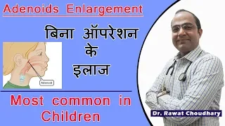 Adenoids Enlargement | Cure Without Operation | Most Common in Children