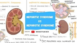 What is the difference between Nephritic and Nephrotic syndrome | MedStudier