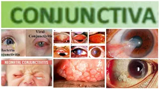 Conjuctiva 4 Major: Viral Conjunctivitis and Membraneous Conjunctivitis