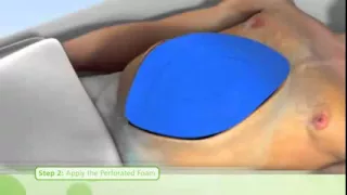 KCI ABThera Open Abdomen OA Negative Pressure Therapy NPT   Application Video