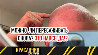 2 месяц после пересадки волос: надолго ли это? Насколько они крепкие  / КРАСАВЧИК