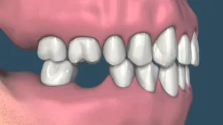 Efeito da perda dentária: Extração 46, mesialização do 47, extrusão superior