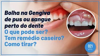 Bolha na Gengiva de pus ou sangue perto do dente. O que pode ser? Tem remédio caseiro? Como tirar?