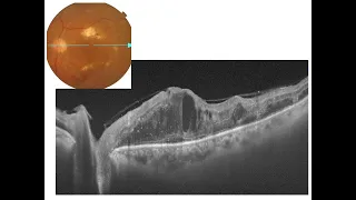 Interpretation  of OCT Macula (Ocular Coherence Tomography)