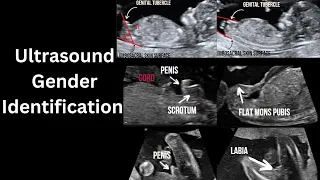 Ultrasound gender determination. How to identify? How accurate?