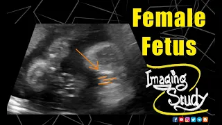 Female Fetus - Its a Girl || Ultrasound || Case 127