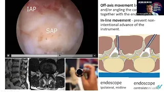Basic steps and management for lumbar endoscopic ULBD - Jin Sung Luke Kim, MD