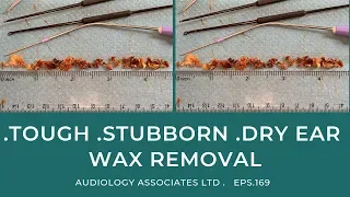 🔴TOUGH 🔴STUBBORN 🔴DRY EAR WAX REMOVAL - EP 169