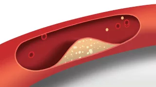 Blood Pressure Animation | Heart disease risk factors