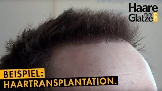 Haartransplantation: Beispielvideo mit Vorher/Nachher-Vergleich