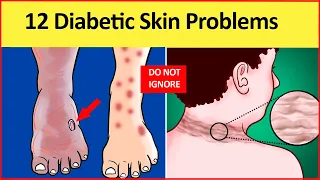 12 Diabetic Skin Problems & Top Signs of Diabetes on The Skin! Don't ignore!