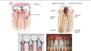 Basic Oral Health for HIV Patients