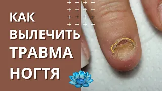 Травма ногтя. Как восстановить ногтевую пластину.