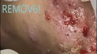 ​Acne Treatment(83)COMPLEX CASE: Keratosis Obturans