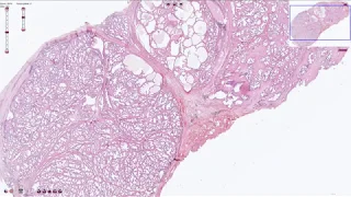 Nodular Prostatic Hyperplasia - Histopathology