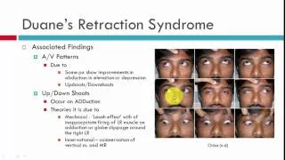 Duane's Retraction Syndrome Clinical Characteristics