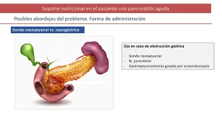 SOPORTE NUTRICIONAL EN EL PACIENTE CON PANCREATITIS AGUDA  Federico Bolado