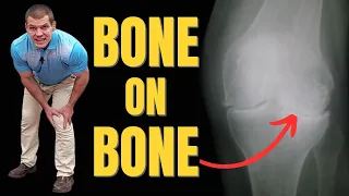 What Can You Do for BONE on BONE Knee Pain Relief? (without Surgery)