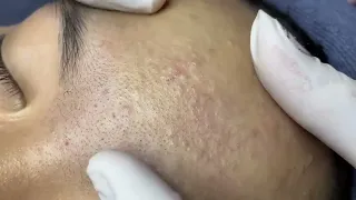 Satisfying and relaxing blackheads, whiteheads, acne treatment, pimple pop - Chuyen Nguyen Spa #03