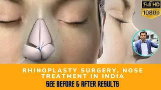 Rhinoplasty, Nose Surgery (Nose Job) in India | Before After Results- The Esthetic Clinics