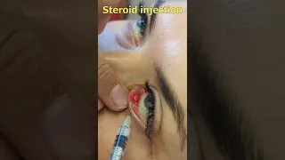 Chalazion treatment with steroid injection | Халязіон. Ін'єкція стероїда