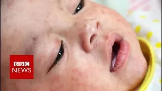 Why is there a measles outbreak in Europe? BBC News