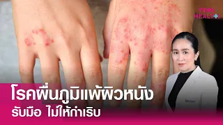 โรคผื่นภูมิแพ้ผิวหนัง รับมือ ไม่ให้กำเริบ : TNN Health