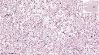 Pneumocystis Jirovecii Pneumonia - Histopathology