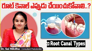 రూట్ కెనాల్ - పూర్తి వివరణ | Types & Indications Of Root Canal Treatment | Eledent Dental Hospitals