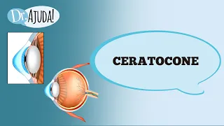 Ceratocone