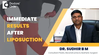 How soon after Liposuction will I see the results? #plasticsurgeon - Dr. Sudhir B M| Doctors' Circle